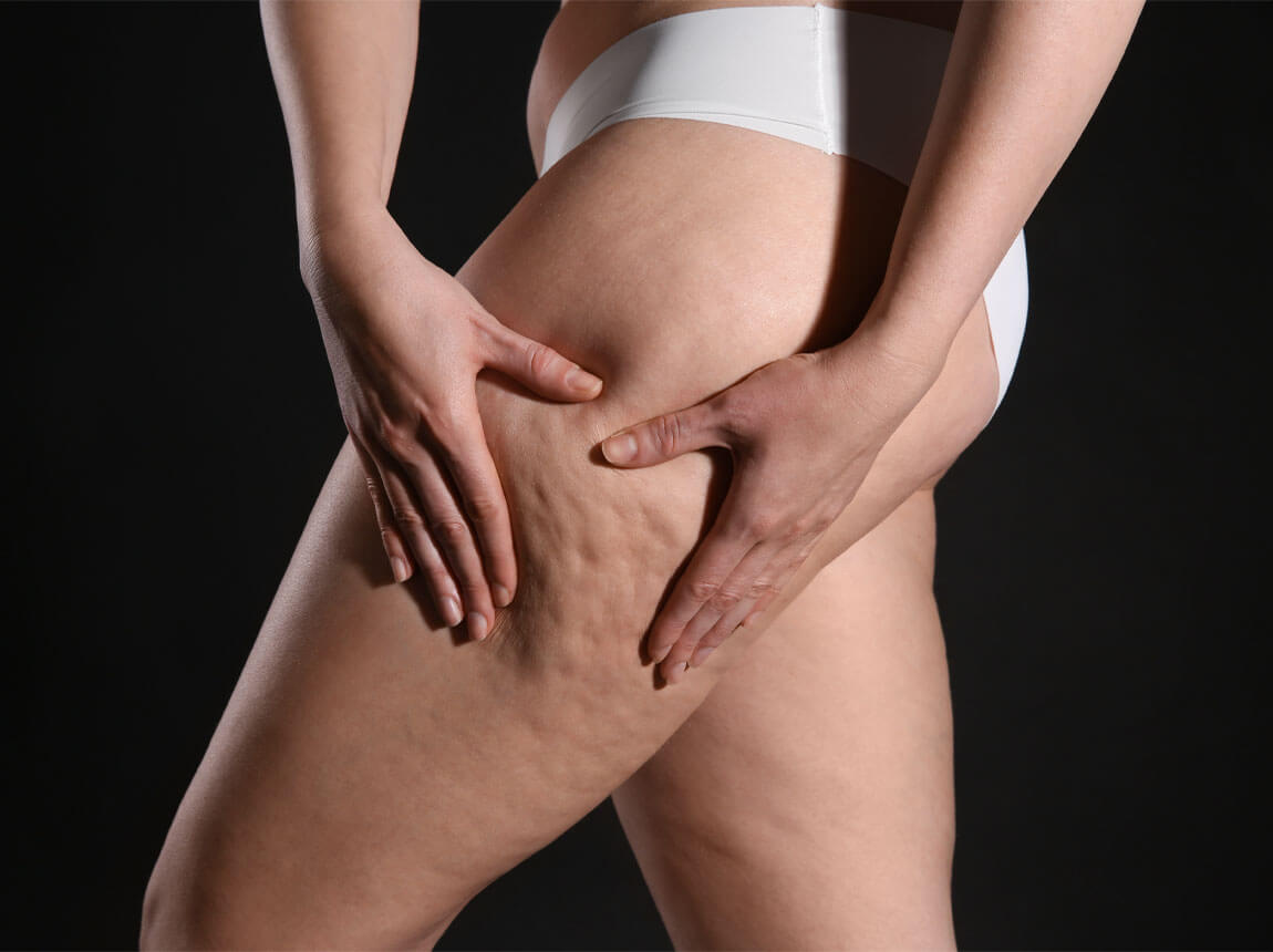 cellulite
