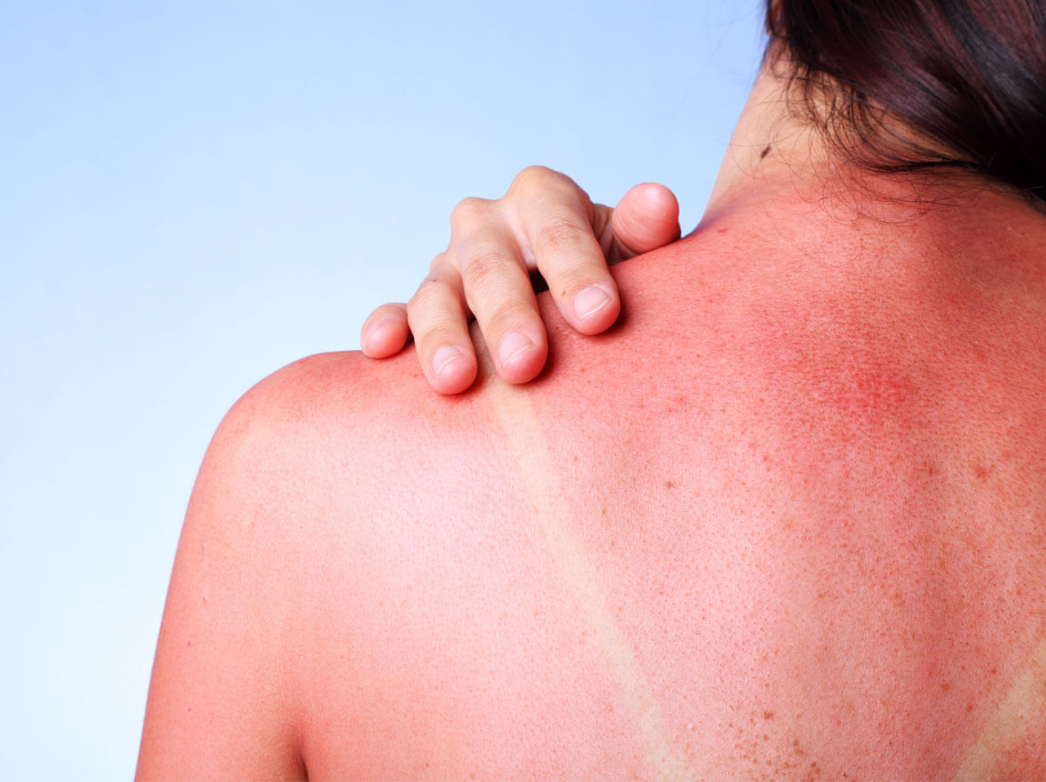 sunburn - skin burns