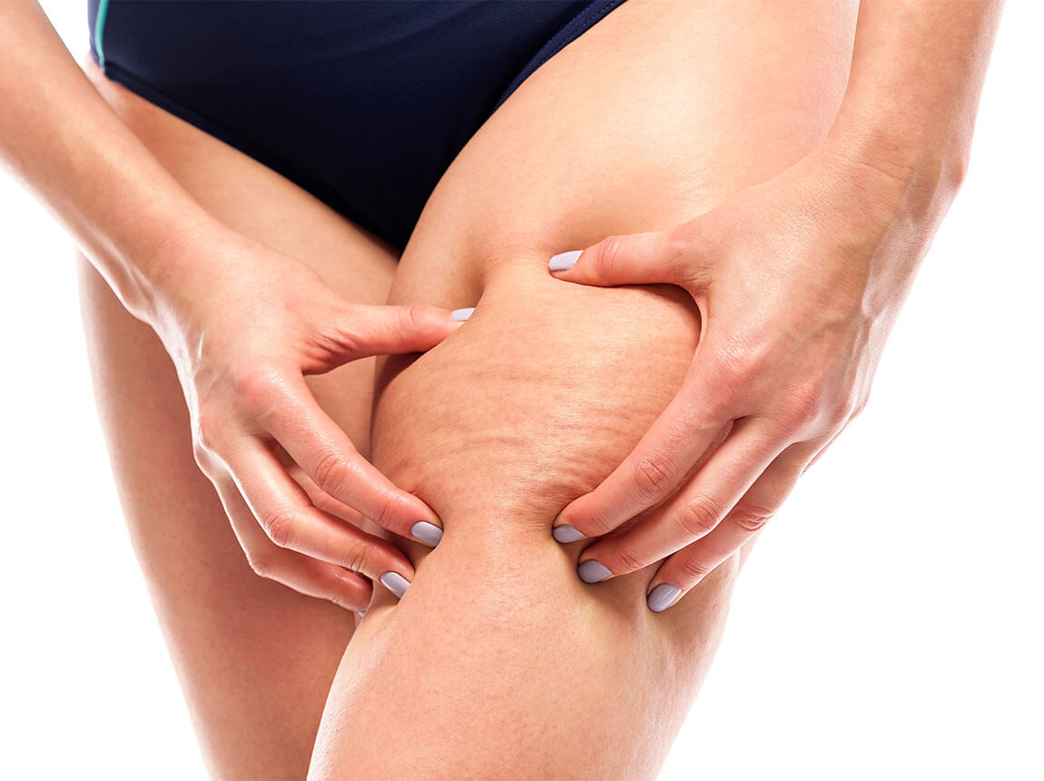 cellulite on the legs