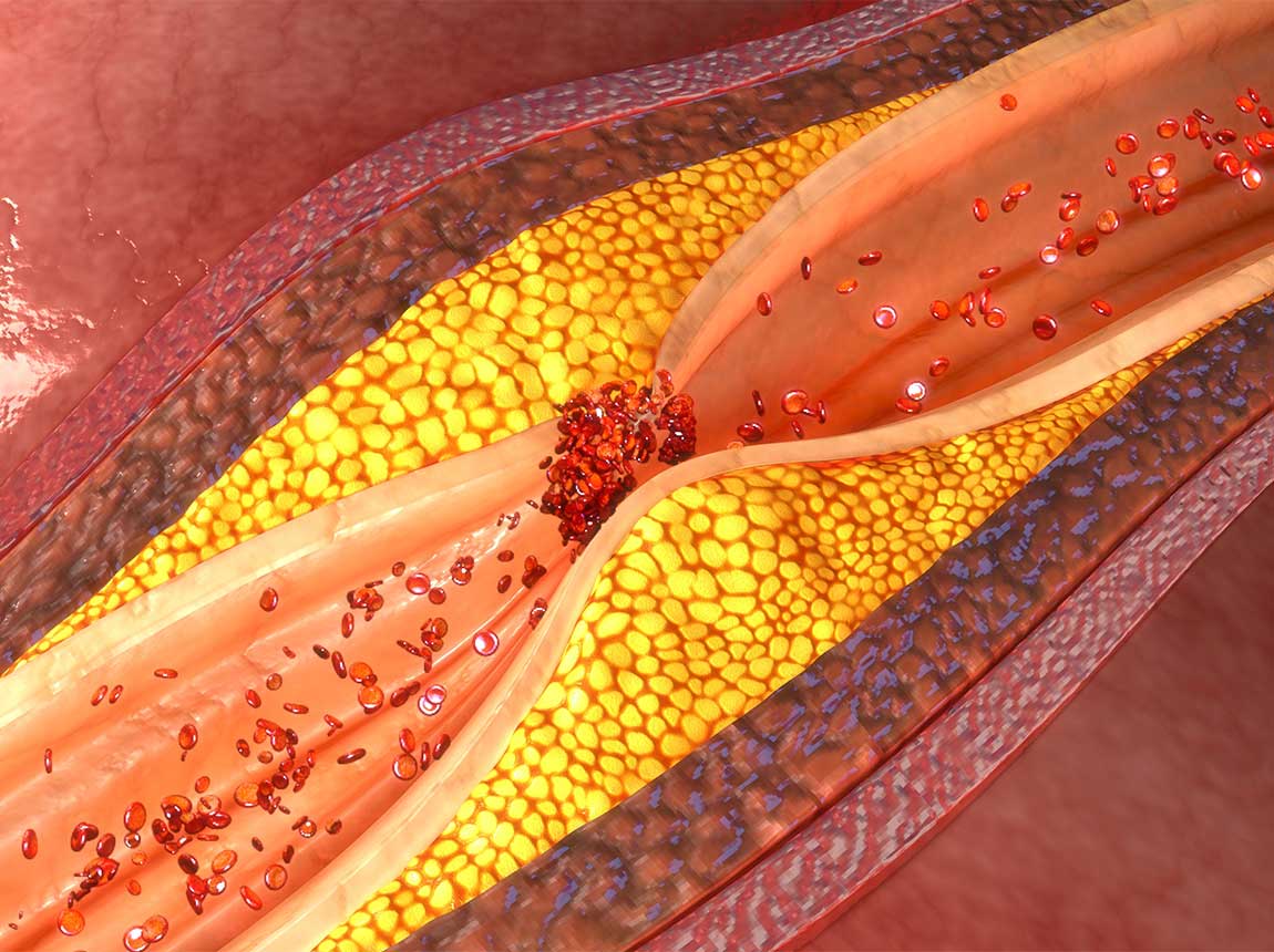 cholesterol