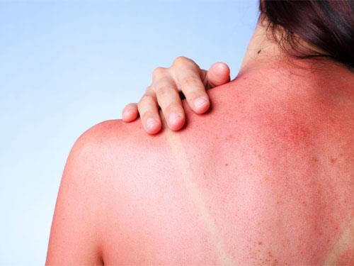 What are some home remedies for sunburn?