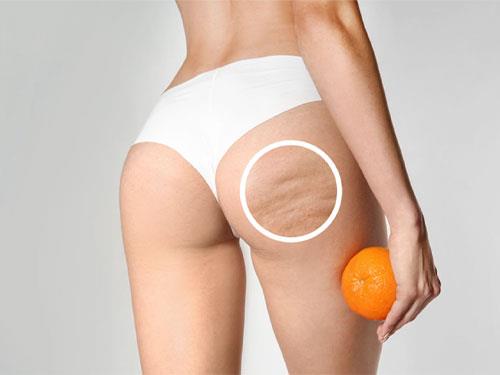 Cellulite on the thighs and buttocks – how to get rid of it?