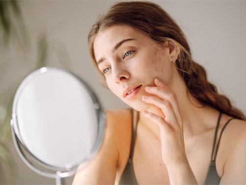 NAC in the fight against acne: does N-acetylcysteine reduce acne?